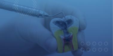 Root Canal Retreatment (any tooth)
